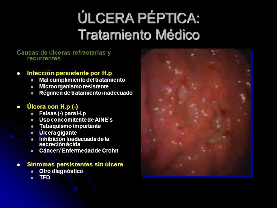 tratamiento para ulcera estomago